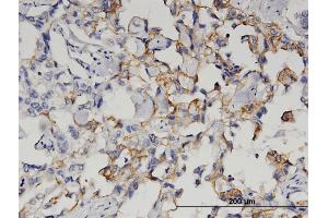Immunoperoxidase of monoclonal antibody to QPCT on formalin-fixed paraffin-embedded human breast cancer. (QPCT 抗体  (AA 262-359))