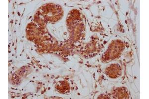 IHC image of ABIN7149430 diluted at 1:500 and staining in paraffin-embedded human breast cancer performed on a Leica BondTM system. (CTLA4 抗体  (AA 37-162))