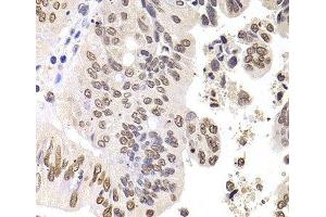 Immunohistochemistry of paraffin-embedded Human colon carcinoma using SOX5 Polyclonal Antibody at dilution of 1:100 (40x lens). (SOX5 抗体)