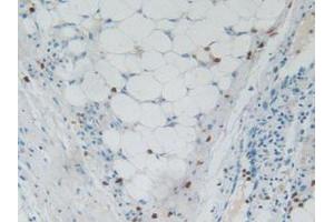 IHC-P analysis of Human Skin Cancer Tissue, with DAB staining. (RNASE3 抗体  (AA 30-154))