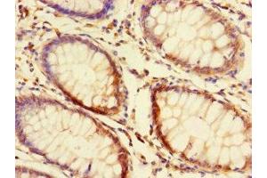 Immunohistochemistry of paraffin-embedded human colon cancer using ABIN7165390 at dilution of 1:100 (FAM131A 抗体  (AA 1-281))