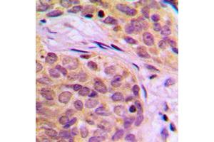 Immunohistochemical analysis of HSPA14 staining in human breast cancer formalin fixed paraffin embedded tissue section. (HSPA14 抗体  (C-Term))