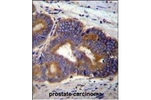Y Antibody (C-term) (ABIN655601 and ABIN2845085) immunohistochemistry analysis in formalin fixed and paraffin embedded human prostate carcinoma followed by peroxidase conjugation of the secondary antibody and DAB staining. (YI016 (AA 253-280), (C-Term) 抗体)