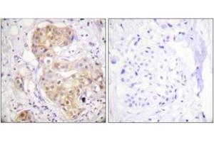 Immunohistochemistry analysis of paraffin-embedded human breast carcinoma tissue, using PKC delta (Ab-505) Antibody. (PKC delta 抗体  (AA 471-520))