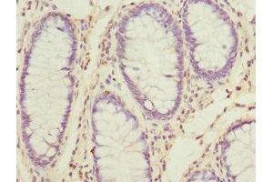 Immunohistochemistry of paraffin-embedded human colon cancer using ABIN7170671 at dilution of 1:100 (SKAP2 抗体  (AA 1-120))