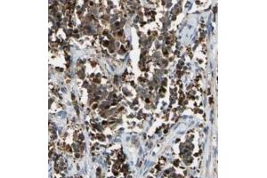 Immunohistochemistry analysis of paraffin-embedded human cervical cancer using BACH1 antibody at dilution of 1/100. (BACH1 抗体)