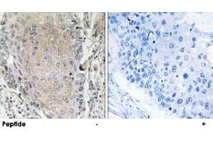 Immunohistochemistry analysis of paraffin-embedded human lung carcinoma tissue using CBLN3 polyclonal antibody . (CBLN3 抗体)