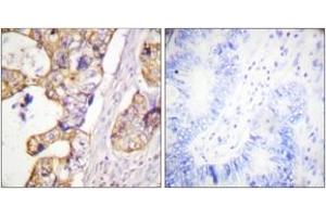 Immunohistochemistry analysis of paraffin-embedded human colon carcinoma tissue, using Keratin 8 (Ab-431) Antibody.