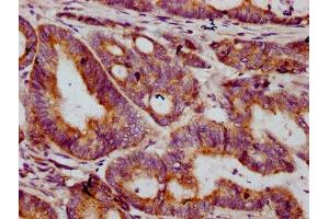 IHC image of ABIN7149158 diluted at 1:400 and staining in paraffin-embedded human colon cancer performed on a Leica BondTM system. (COX2 抗体  (AA 83-227))