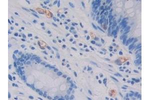 Detection of GC in Human Stomach cancer Tissue using Polyclonal Antibody to Glycocalicin (GC) (Glycocalicin 抗体  (AA 136-276))