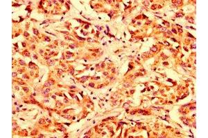 IHC image of ABIN7159933 diluted at 1:300 and staining in paraffin-embedded human liver cancer performed on a Leica BondTM system. (LETM1 抗体  (AA 443-543))