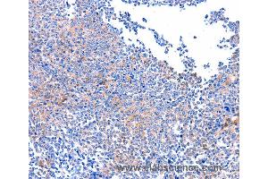 Immunohistochemistry of Human ovarian cancer using PTK2 Polyclonal Antibody at dilution of 1:75 (FAK 抗体)