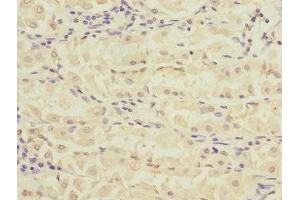Immunohistochemistry of paraffin-embedded human gastric cancer using ABIN7168157 at dilution of 1:100 (Ribose 5-Phosphate Isomerase A (RPIA) (AA 82-311) 抗体)
