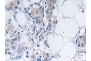 Detection of SRY in Human Breast cancer Tissue using Polyclonal Antibody to Sex Determining Region Y (SRY) (SRY 抗体  (AA 1-204))