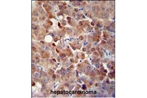 CHRDL1 antibody (N-term) (ABIN654624 and ABIN2844321) immunohistochemistry analysis in formalin fixed and paraffin embedded human hepatocarcinoma followed by peroxidase conjugation of the secondary antibody and DAB staining. (CHRDL1 抗体  (N-Term))