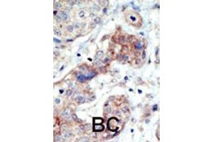 Formalin-fixed and paraffin-embedded human cancer tissue reacted with the primary antibody, which was peroxidase-conjugated to the secondary antibody, followed by DAB staining. (EPH Receptor B3 抗体  (N-Term))