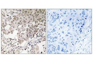 Immunohistochemistry analysis of paraffin-embedded human lung carcinoma tissue using NCAPG2 antibody. (NCAPG2 抗体  (Internal Region))