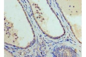 Immunohistochemistry of paraffin-embedded human prostate cancer using ABIN7152009 at dilution of 1:100 (GATA1 抗体  (AA 39-153))