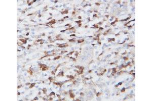 Anti-GRP94 antibody, IHC(P) IHC(P): Human Lung Cancer Tissue
