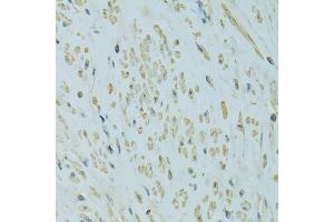 Immunohistochemistry of paraffin-embedded human uterine cancer using UGT1A6 antibody. (UGT1A6 抗体)