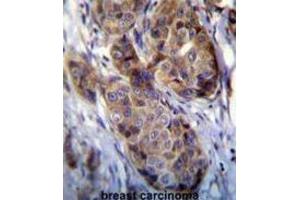 Immunohistochemistry (IHC) image for anti-Melanoma Antigen Family A, 12 (MAGEA12) antibody (ABIN3002530) (MAGEA12 抗体)