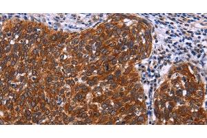 Immunohistochemistry of paraffin-embedded Human cervical cancer tissue using USP2 Polyclonal Antibody at dilution 1:40 (USP2 抗体)