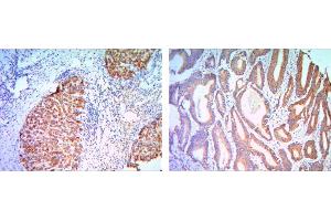 Immunohistochemical analysis of paraffin-embedded liver cancer (right) and colon cancer tissues (left) using KLHL11 mouse mAb with DAB staining. (KLHL11 抗体)