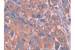 IHC-P analysis of Human Breast cancer Tissue, with DAB staining. (Complement Factor B 抗体  (AA 35-160))