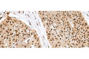 Immunohistochemistry of paraffin-embedded Human esophagus cancer tissue using FBXO32 Polyclonal Antibody at dilution of 1:60(x200) (FBXO32 抗体)