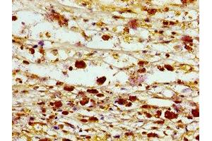 Immunohistochemistry of paraffin-embedded human melanoma using ABIN7161402 at dilution of 1:100 (Septin 3 抗体  (AA 238-358))