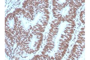Formalin-fixed, paraffin-embedded human Colon Carcinoma stained with PAX2 Mouse Monoclonal Antibody (PAX2/1104). (PAX2A 抗体  (AA 223-354))