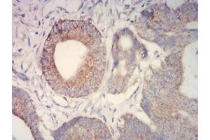 Immunohistochemical analysis of paraffin-embedded colon cancer tissues using IDH2 mouse mAb with DAB staining.