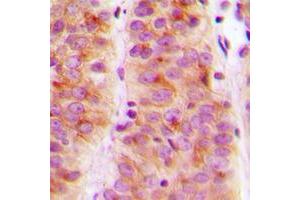 Immunohistochemical analysis of SLK staining in human breast cancer formalin fixed paraffin embedded tissue section. (SLK 抗体  (C-Term))