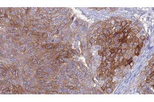 ABIN6276957 at 1/100 staining Human urothelial cancer tissue by IHC-P. (Macrophage Scavenger Receptor 1 抗体  (N-Term))