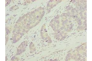 Immunohistochemistry of paraffin-embedded human gastric cancer using ABIN7163654 at dilution of 1:100 (GNRPX 抗体  (AA 1-149))