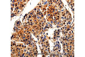 Immunohistochemistry of Human liver cancer using APLP1 Polyclonal Antibody at dilution of 1:10 (APLP1 抗体)