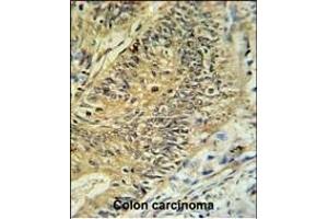 RPS15A Antibody (N-term) (ABIN650999 and ABIN2840032) IHC analysis in formalin fixed and paraffin embedded colon carcinoma followed by peroxidase conjugation of the secondary antibody and DAB staining. (RPS15A 抗体  (N-Term))