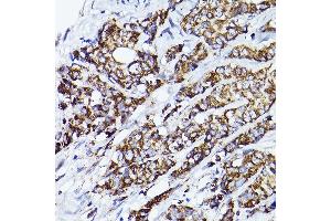 Immunohistochemistry of paraffin-embedded human breast cancer using VD Rabbit pAb (ABIN7271337) at dilution of 1:150 (40x lens). (VDAC2 抗体  (AA 1-100))