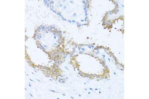 Immunohistochemistry of paraffin-embedded human breast using N antibody (ABIN6132387, ABIN6144378, ABIN6144379 and ABIN6216511) at dilution of 1:100 (40x lens). (NAT2 抗体  (AA 171-290))