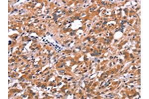 The image on the left is immunohistochemistry of paraffin-embedded Human thyroid cancer tissue using ABIN7190640(FDCSP Antibody) at dilution 1/25, on the right is treated with synthetic peptide. (FDCSP 抗体)