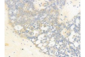 ABIN6259121 and ABIN6275271 at 1/100 staining human ovarian carcinoma by IHC-P.