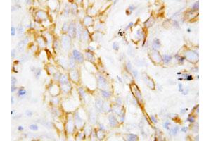 Immunohistochemical staining of paraffin-embedded human lung cancer tissue section with DEFB1 polyclonal antibody . (beta Defensin 1 抗体  (C-Term))