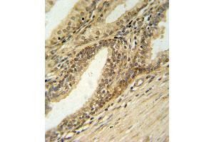 DFFB Antibody (N-term) (ABIN653798 and ABIN2843079) IHC analysis in formalin fixed and paraffin embedded prostate carcinoma followed by peroxidase conjugation of the secondary antibody and DAB staining.