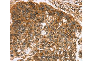 Immunohistochemistry of Human esophagus cancer using TNFSF15 Polyclonal Antibody at dilution of 1:40 (TNFSF15 抗体)