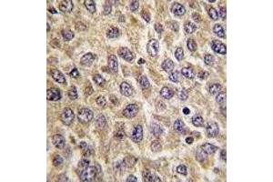 IHC analysis of FFPE human hepatocarcinoma tissue stained with ILK antibody (ILK 抗体  (AA 225-253))
