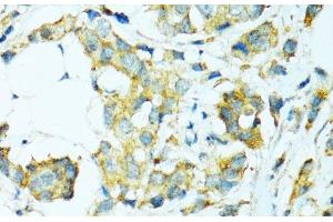Immunohistochemistry of paraffin-embedded Human breast cancer using CYP2B6 Polyclonal Antibody at dilution of 1:100 (40x lens). (CYP2B6 抗体)