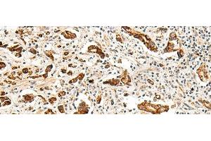 Immunohistochemistry of paraffin-embedded Human prost at e cancer tissue using GPR160 Polyclonal Antibody at dilution of 1:35(x200) (GPR160 抗体)