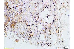 Formalin-fixed and paraffin embedded human colon carcinoma labeled with Rabbit Anti-MMP-7 Polyclonal Antibody, Unconjugated  at 1:200 followed by conjugation to the secondary antibody and DAB staining. (MMP7 抗体  (AA 151-250))