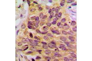 Immunohistochemical analysis of MRPL39 staining in human breast cancer formalin fixed paraffin embedded tissue section.