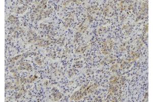 ABIN6277021 at 1/100 staining Human lung cancer tissue by IHC-P. (TPSAB1 抗体  (C-Term))